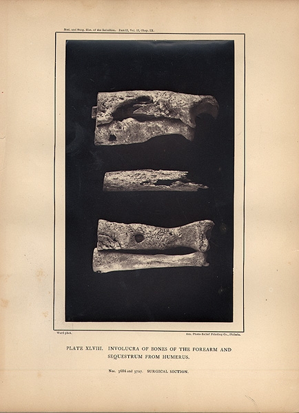 PHOTOGRAPH FROM MEDICAL & SURGICAL HISTORY OF THE WAR OF THE REBELLION