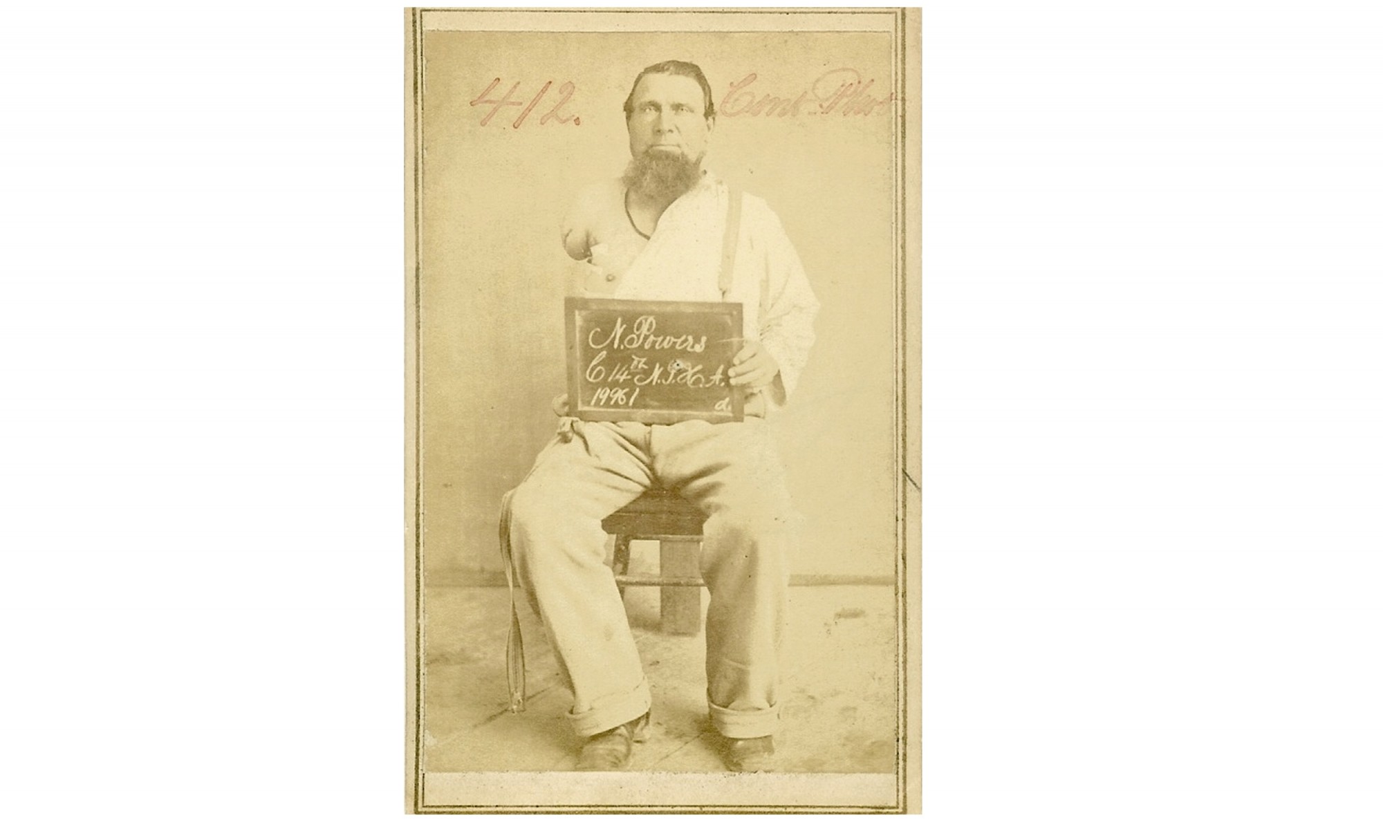 US MEDICAL DEPT. CDV IMAGE OF SOLDIER AMPUTEE PVT. NICHOLAS POWERS, 14TH NEW YORK HEAVY ARTILLERY